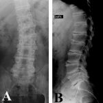 Fig. 1 Radiographs at patient presentation. Fig. 1-A Anteroposterior radiograph of the lumbar spine showing scoliosis and osteophytes. Fig. 1-B Lateral radiograph providing better appreciation of disc-space narrowing and thinned discs, osteophytes, and advanced Thompson Grade-V disc degeneration.
