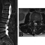 Fig. 2 T2-weighted MRI scans obtained 6 months following the radiographs in Figure 1; at this time, the L2-L3 herniation is prominent (Fig. 2-B).
