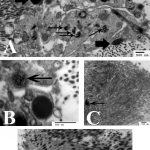 Fig. 4 Transmission electron microscopy of anulus tissue revealing the presence of small shard inclusions (Fig. 4-A, small arrows) within disc cells and larger inclusions in nearby extracellular matrix (Fig. 4-A, large arrows). Occasional finer pigmented inclusions were also present (Fig. 4-B, arrow). Extracellular matrix abnormalities included loosely organized regions with thin collagen fibers and occasional inclusions (Fig. 4-C, arrow), and collagen fibers seen in longitudinal section with accumulations of electron-dense stained material (Fig. 4-D, black regions) (bar = 500 nm).
