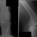 A 66-Year-Old Man with Worsening Knee Pain