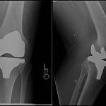 Fig. 2 Postoperative radiographs following the left total knee arthroplasty in 2006. Poor-quality anteroposterior (left) and lateral (right) views demonstrate good alignment and implant position without definite signs of intraosseous or intra-articular lesions.

