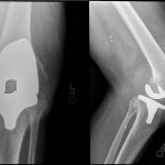 Fig. 3 In 2009, anteroposterior (left) and lateral (right) views were limited because of the flexed position of the knee. These images demonstrate anterior, distal metaphyseal, and marginal bicondylar femoral lucency in the presence of a total knee arthroplasty implant. A large radiodense mass without distinct calcifications is noted throughout the knee joint and fills the suprapatellar pouch.
