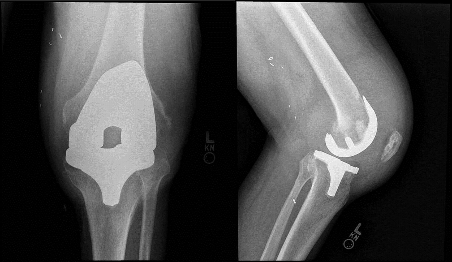 A 66 Year Old Man With Worsening Knee Pain JBJS Image Quiz