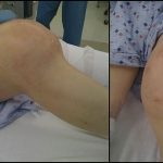 Fig. 4 Clinical lateral (left) and anteroposterior (right) photographs taken prior to definitive surgery in 2009 depict a large knee mass with an overlying well-healed anterior midline total knee arthroplasty scar.
