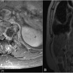 Fig. 3 Axial (Fig. 3-A) and sagittal (Fig. 3-B) MRI with contrast, showing lesion expansion and worsening cord compression.
