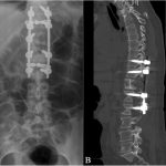 Fig. 5 Postoperative imaging. Fig. 5-A Anteroposterior radiograph of the thoracolumbar spine. Fig. 5-B MRI showing partial corpectomy with rib graft and complete laminectomy.
