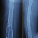 Fig. 3 Anteroposterior (left panel) and lateral (right panel) radiographs of the right femoral shaft showing the diaphyseal lesion that was treated with curettage and bone allograft.

