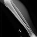 A 65-Year-Old Man with Worsening Calf Pain