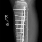Fig. 10 Lateral radiograph of the reconstruction showing an anterior tibial cortex fracture and hardware failure in the distal aspect of the tibia.
