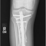 Fig. 11 Postoperative anteroposterior radiograph after intramedullary nailing of the pathologic fracture of the left tibia.
