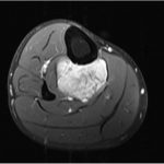 Fig. 3 On initial presentation, axial T1-weighted gadolinium fat-suppressed (FS) MRI of the right lower extremity reveals a heterogeneous mass with no intramedullary involvement of the tibia (TR, 620 ms; TE, 11 ms).
