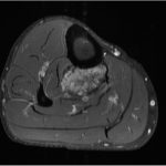 Fig. 4 As demonstrated by axial T1-weighted gadolinium FS MRI (TR, 918 ms; TE, 9.79 ms), the tumor was reduced to 3.6 × 3.3 × 2.0 cm after 5 cycles of neoadjuvant chemotherapy.
