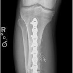 Fig. 9 Anteroposterior radiograph made during adjuvant chemotherapy demonstrating failure of the allograft reconstruction with an anterior tibial cortex fracture.
