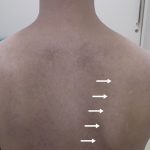 Fig. 1-A Clinical photograph. The position and rotation of the scapulae are asymmetric with the arms at the side. The right scapula (arrows) is located laterally and inclined inferiorly, and its medial border protrudes when compared with the left side.
