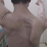 Fig. 1-B Clinical photograph. Inferior rotation and prominence of the medial border of the scapula were apparent during shoulder elevation, and active range of shoulder elevation was restricted to 90°.
