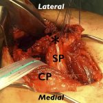 Fig. 3-A Intraoperative photograph. For the operation, the patient was placed in the left lateral decubitus position. The sternal portion of the pectoralis major muscle was harvested from its insertion with a 4-cm-long piece of the humeral shaft (*) through a 6-cm anterior skin incision. SP = sternal portion of the pectoralis major and CP = clavicular portion of the pectoralis major.
