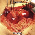 Fig. 3-D Intraoperative photograph. An 8-cm-long incision was made, and the levator scapulae (LS), rhomboid minor (Rm), and rhomboid major (RM) muscles were harvested from the medial edge of the right scapula, with small pieces of their respective osseous insertions.
