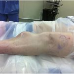 A 64-Year-Old Woman with a Slow Growth on the Leg
