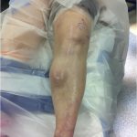 Fig. 1-B Preoperative anterior image showing a diaphyseal nontender soft-tissue mass measuring 5 × 6 cm in the left tibia.
