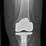 Fig. 2-A Anteroposterior radiograph of the left total knee arthroplasty demonstrate a tricompartmental hybrid posterior Cruciate Retaining NexGen total knee implant (Zimmer). The femoral angle was 6° valgus, the tibial alignment was neutral, and the tibiofemoral angle was 6° valgus. There was no radiographic evidence of component loosening.
