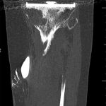 Fig. 3-A Coronal CT arthrogram view showing direct communication between the knee joint and the cyst.
