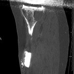 Fig. 3-B Sagittal CT arthrogram views showing direct communication between the knee joint and the cyst.
