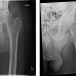 Fig. 1 Preoperative anteroposterior (left) and cross-table (right) radiographs of the left hip demonstrating osteonecrosis of the femoral head with segmental collapse and secondary osteoarthritis.
