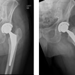 Fig. 2 Anteroposterior (left) and cross-table (right) radiographs of the left hip six months after total hip arthroplasty showing cementless components without evidence of subsidence. Normal bone morphology and moderate heterotopic ossification are present.
