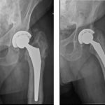 Fig. 3 Anteroposterior (left) and cross-table (right) radiographs of the left hip two years after primary arthroplasty demonstrating substantial femoral stem subsidence, cortical thickening, periostitis, and expansion of the greater trochanteric region.

