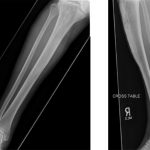 Fig. 4 Anteroposterior (left) and lateral (right) radiographs of the right tibia showing an expanded mixed lytic and sclerotic lesion of the anterior tibial cortex extending from the proximal articular surface to the midshaft.
