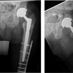 Fig. 6 Postrevision anteroposterior (left) and cross-table (right) radiographs of the left hip and the femur showing a long revision stem with a lateral cable-plate construct (bypassing an anterior cortical perforation).
