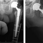 Fig. 7 Anteroposterior (left) and cross-table (right) radiographs of the left hip and the femur showing no change in hardware position at the two-year follow-up.
