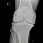 Fig. 1-A Anteroposterior preoperative radiograph of the right knee showing osteoarthritic changes.
