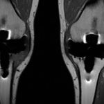 Fig. 2-A Coronal-section MRI of both knees taken six months following the right total knee arthroplasty demonstrates cortical disruption of the proximal part of the medial aspect of the tibia
