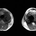 Fig. 2-B Axial-section MRI of both knees taken six months following the right total knee arthroplasty.
