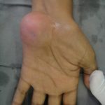 Fig. 1 Clinical photograph of the left hand: palmar view.
