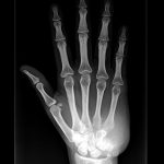 Fig. 2 Anteroposterior radiograph of the hand and wrist.
