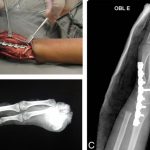Fig. 6 Figs. 6-A, 6-B, and 6-C: Arthrodesis of the wrist. Fig. 6-A The arthrodesis was used to stabilize the wrist after resection. Fig. 6-B Radiograph of the specimen demonstrating wide resection. Fig. 6-C Radiograph of the wrist arthrodesis.
