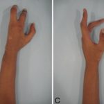 Fig. 7 Figs. 7-A through 7-D: The final clinical function of the remaining hand: palm (Fig. 7-A), back of hand (Fig. 7-B), and flexion of the fingers (Figs. 7-C and 7-D).
