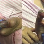 Fig. 1 Clinical photographs of the thumb at presentation. Erythema and ecchymosis are present, but there is no associated tenderness, fluctuance, or open wound.
