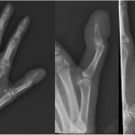 Fig. 2 Radiographs, including an anteroposterior view of the hand (left) and lateral (middle) and oblique (right) views of the thumb. An expansile lytic lesion in the distal phalanx is seen, with an associated tuft fracture. Swelling of the soft tissue about the distal aspect of the phalanx is also noted.
