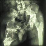 Fig. 1-A Preoperative anteroposterior radiograph of the hip showing the extruding acetabulum with a huge deformed femoral head.
