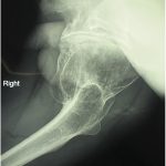 ig. 1-B Preoperative lateral radiograph of the hip showing the extruding acetabulum with a huge deformed femoral head.
