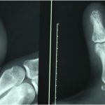 Fig. 1 Preoperative lateral (left) and anteroposterior (right) radiographs of the thumb revealed lytic lesions with a honeycomb appearance in the distal phalanx, without remarkable cortical expansion or periosteal reaction.
