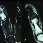 Fig. 3 Figs. 3-A and 3-B: MRI scans. Fig. 3-A: T2-weighted fat suppression MRI demonstrated abnormal high signal intensity in the distal phalanx of the thumb. Fig. 3-B: T1-weighted MRI showed abnormal low signal intensity without soft-tissue involvement.
