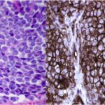 Fig. 4 Figs. 4-A and 4-B: Histopathology and immunohistochemistry. Fig. 4-A: Histopathology showed small blue round cells with prominent nuclei (hematoxylin and eosin stain, ×100 magnification). Fig. 4-B: Immunohistochemistry showed strong CD99 reactivity.
