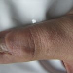 Fig. 6 Clinical photograph of the thumb 3 months after surgery.
