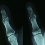 Fig. 7 Two years after surgery, lateral (left) and anteroposterior (right) radiographs of the thumb revealed solid fusion.
