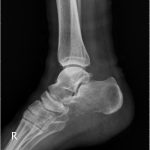 Fig. 1-B Figs. 1-A and 1-B: Anteroposterior (Fig. 1-A) and lateral (Fig. 1-B) radiographs of the right ankle reveal erosion over the plantar cortex of the right calcaneus.

