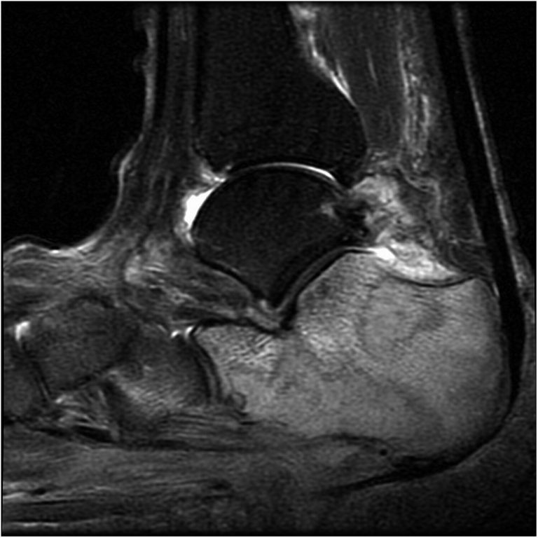 A 51-Year-Old Man with a Worsening Limp - JBJS Image Quiz